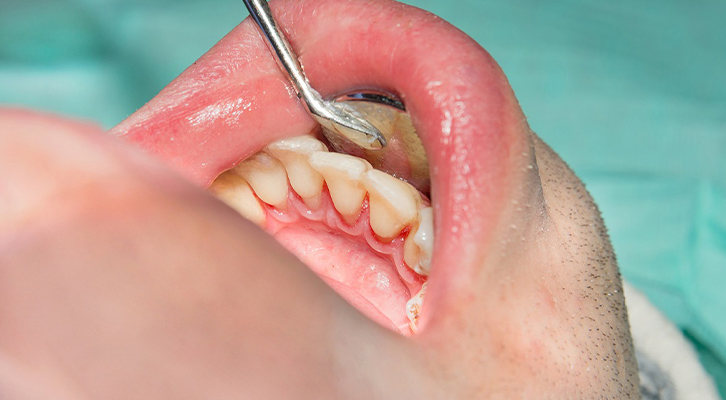 Periodontal Surgeries