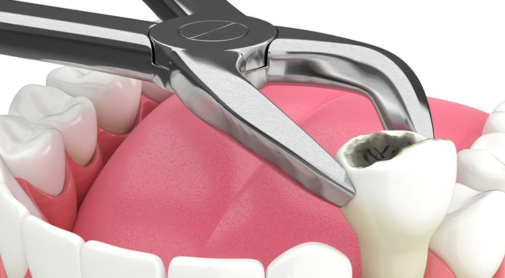 Tooth Extraction