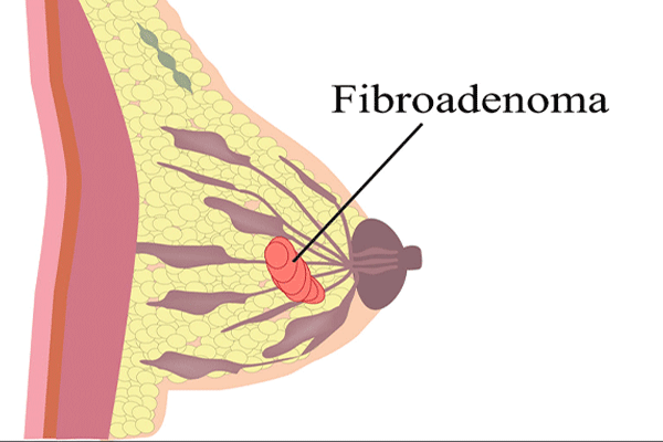Fibroadenoma Surgery