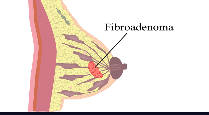 Fibroadenoma