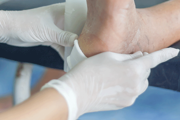 Diabetic Foot Management