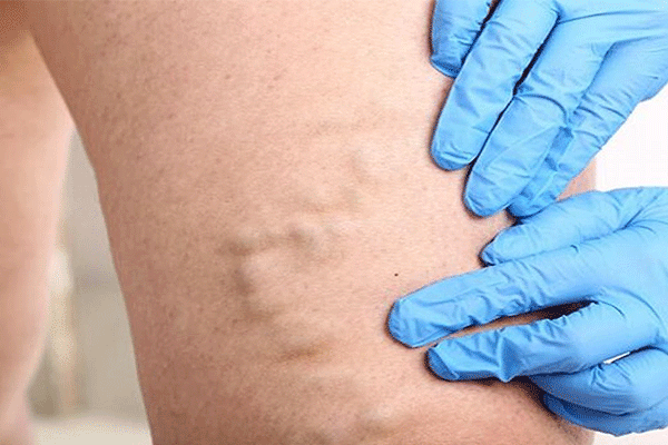 Varicose Vein Treatment