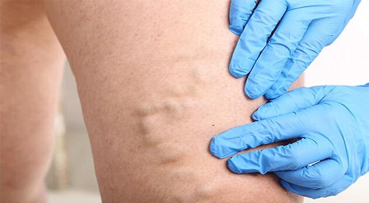 Vein Treatment